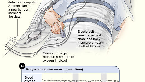 Diagram of a sleep study (polysomnography), showing sensors that record breathing, blood oxygen and sleep stages overnight