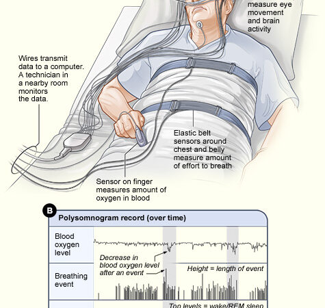 Diagram of a sleep study (polysomnography), showing sensors that record breathing, blood oxygen and sleep stages overnight