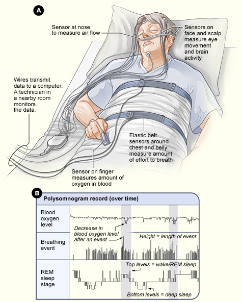 Diagram of a sleep study (polysomnography), showing sensors that record breathing, blood oxygen and sleep stages overnight